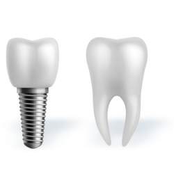 dental implant